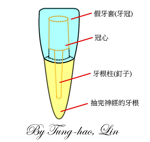 牙根柱與冠心